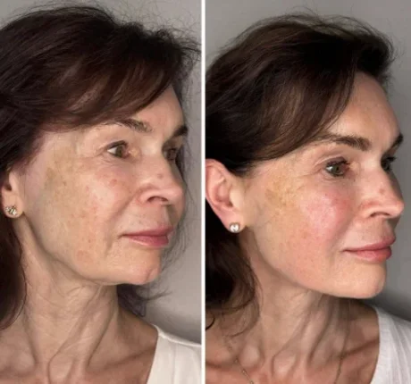 Skin booster before and after — patient 1, Skin Booster Lab Dubai