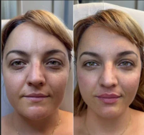 Skin booster before and after — patient 2, Skin Booster Lab Dubai